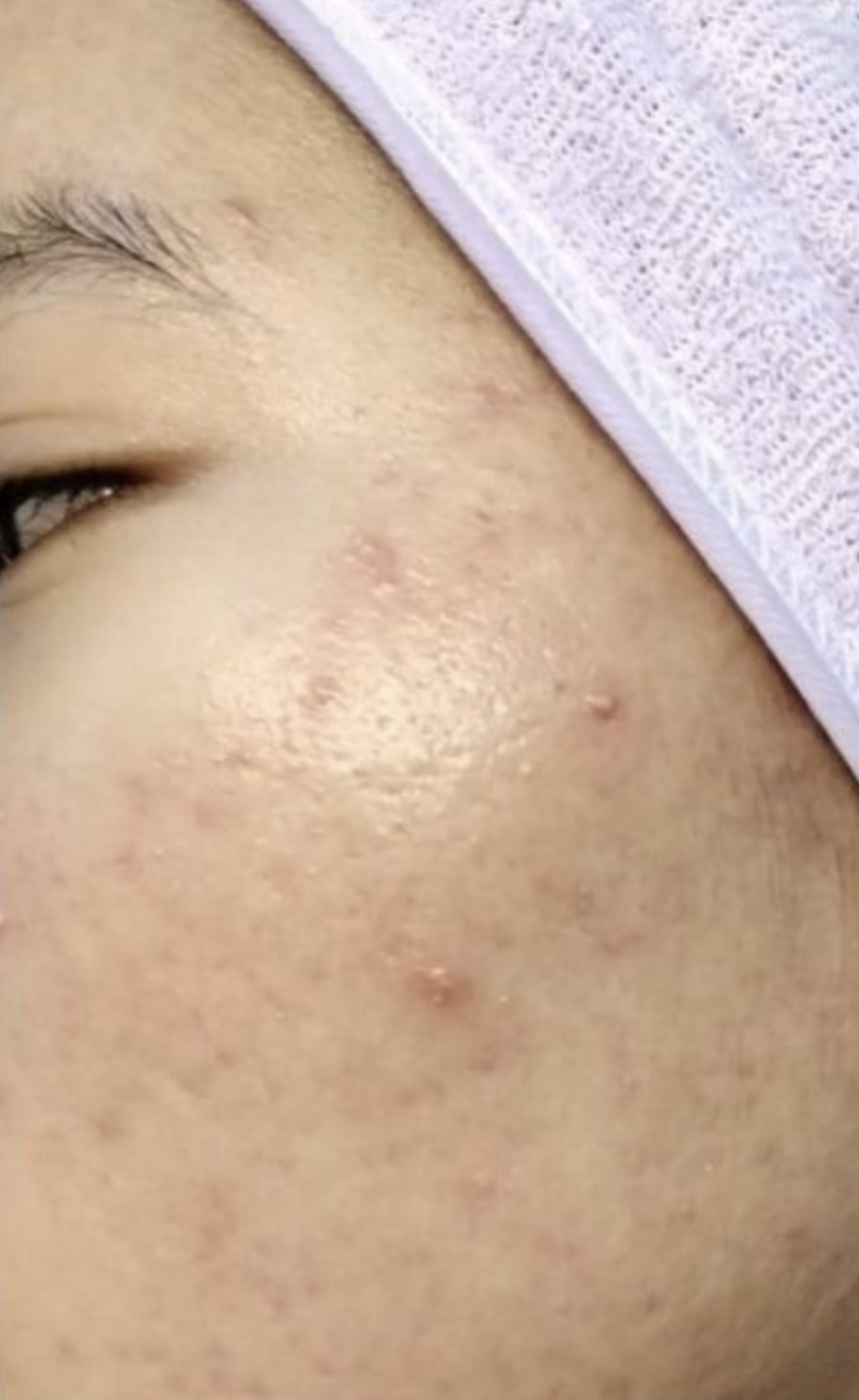After Salmon DNA Skin Booster
