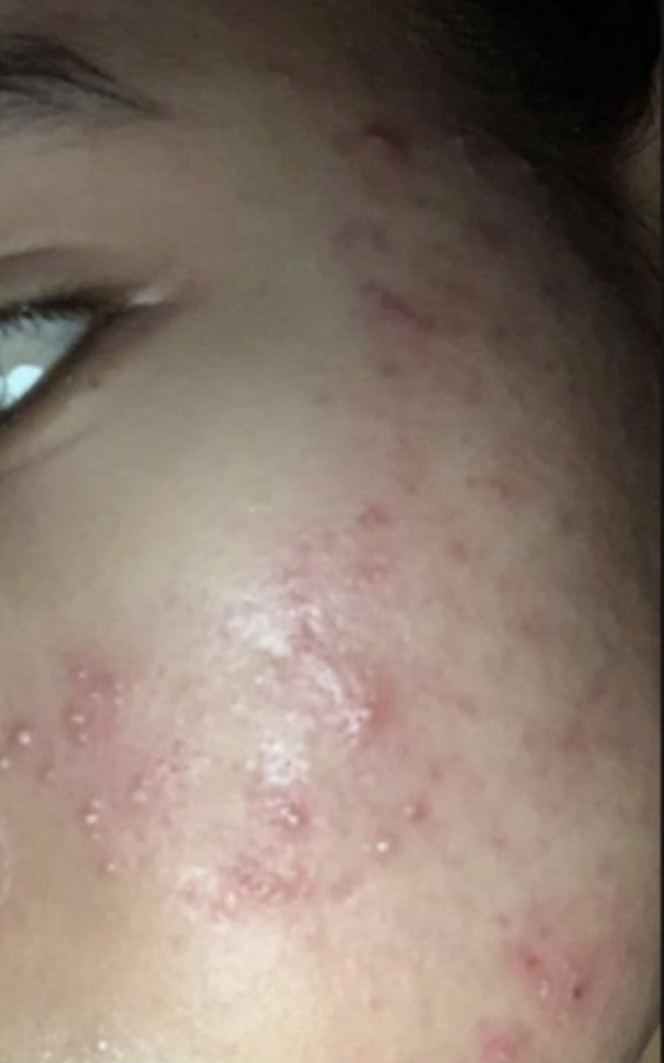Before Salmon DNA Skin Booster